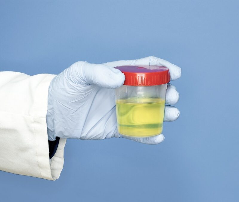 Medical staff holding a urine sample for a drug test