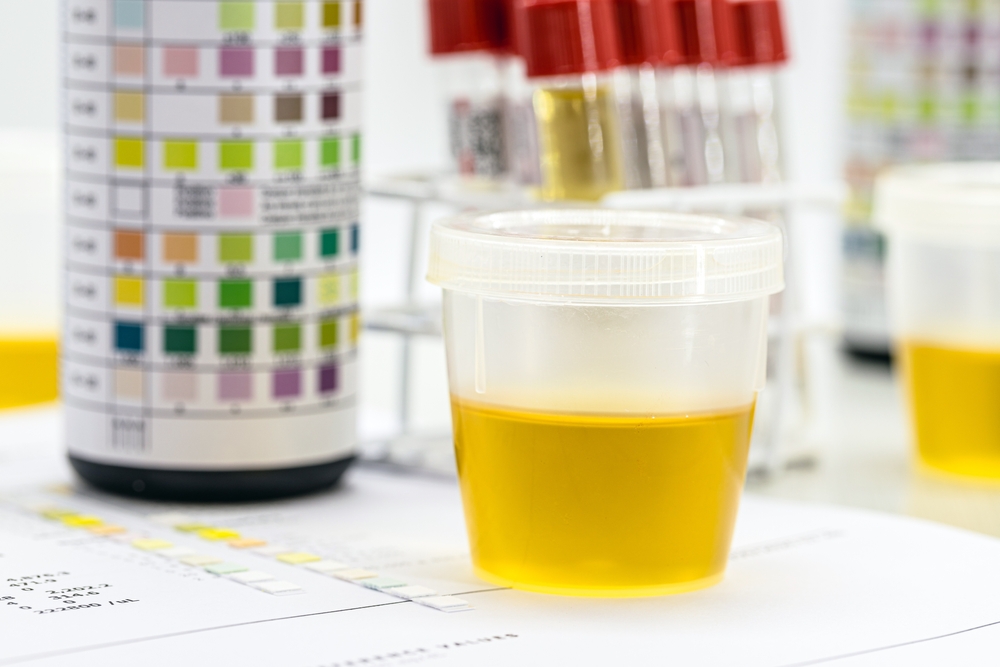 Plastic container of urine test for crack cocaine drug test